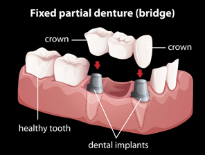 dental implants Sossaman Dental Implants