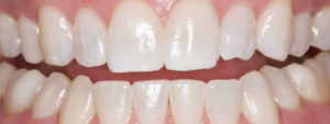 Boost whitening after